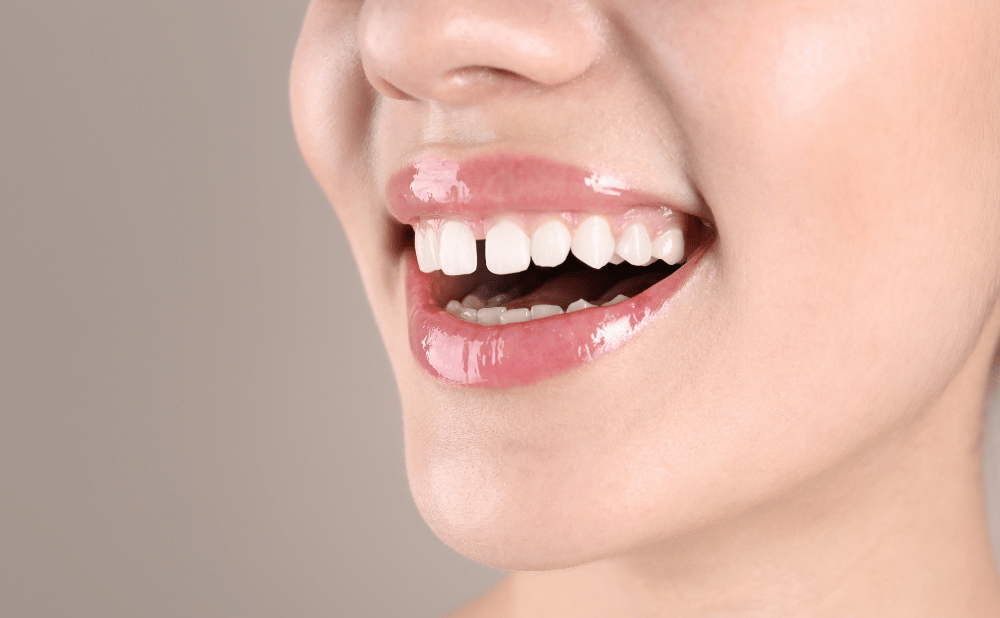 すきっ歯は歯列矯正で治せる？原因・治療法・費用を徹底解説