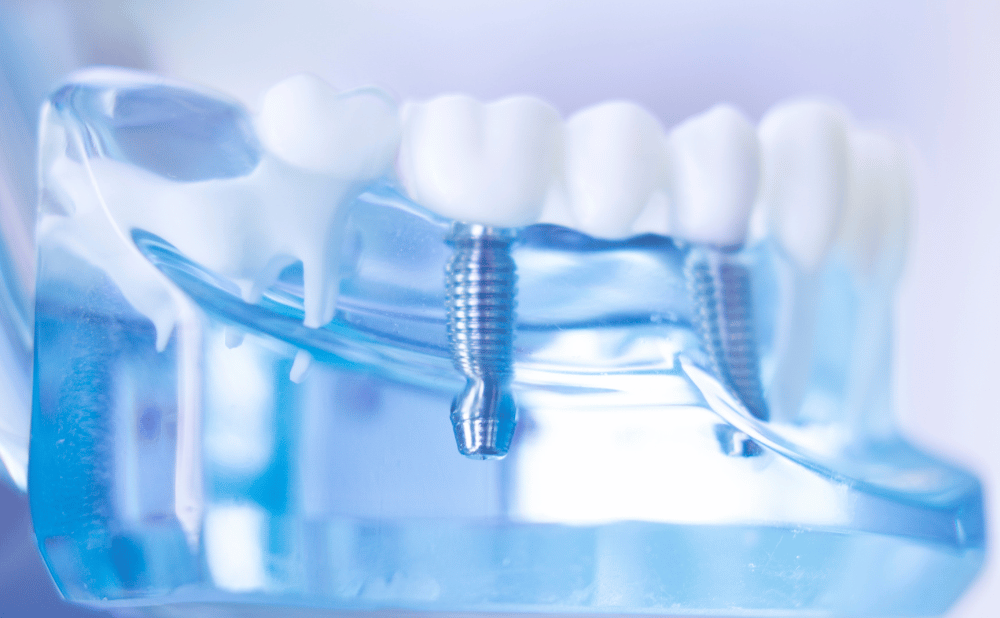 岩倉市でインプラント治療を検討中の方へ！オールオンフォー・ザイゴマにも対応する歯科医院の選び方