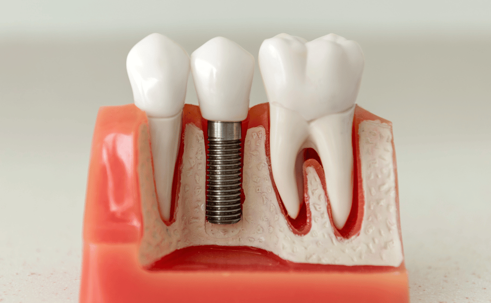 インプラント周囲炎とは？