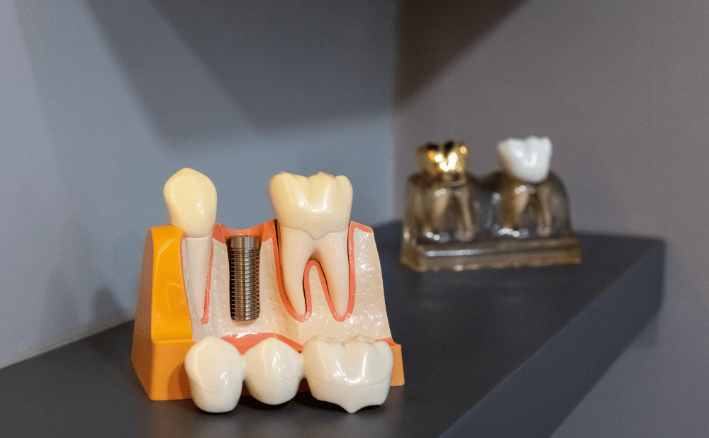 インプラント周囲炎の兆候を見逃さない！初期症状・原因・治療法まとめ