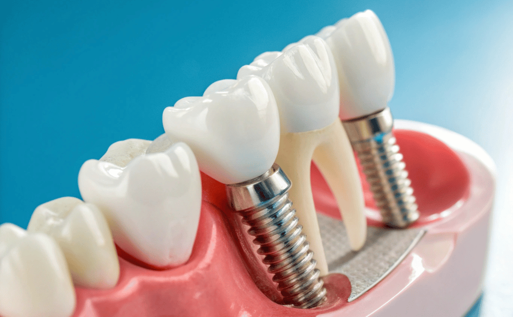 インプラント手術後の食事はいつから可能？当日・翌日・1週間のガイドライン