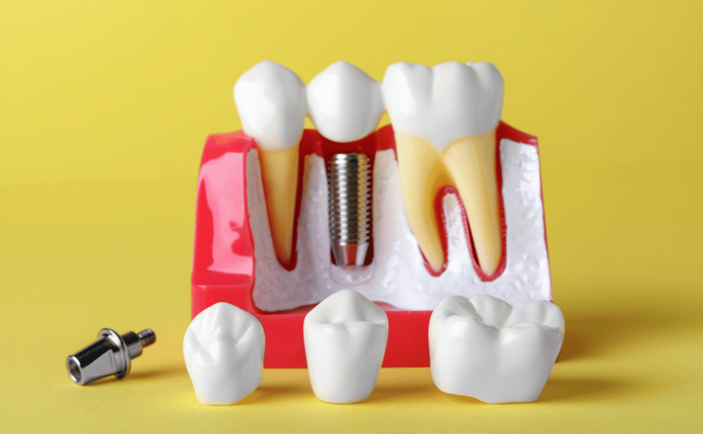 インプラントが何度も取れる原因