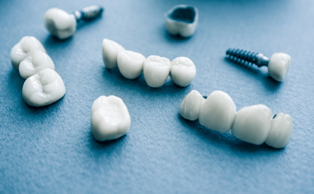 インプラントが取れる原因