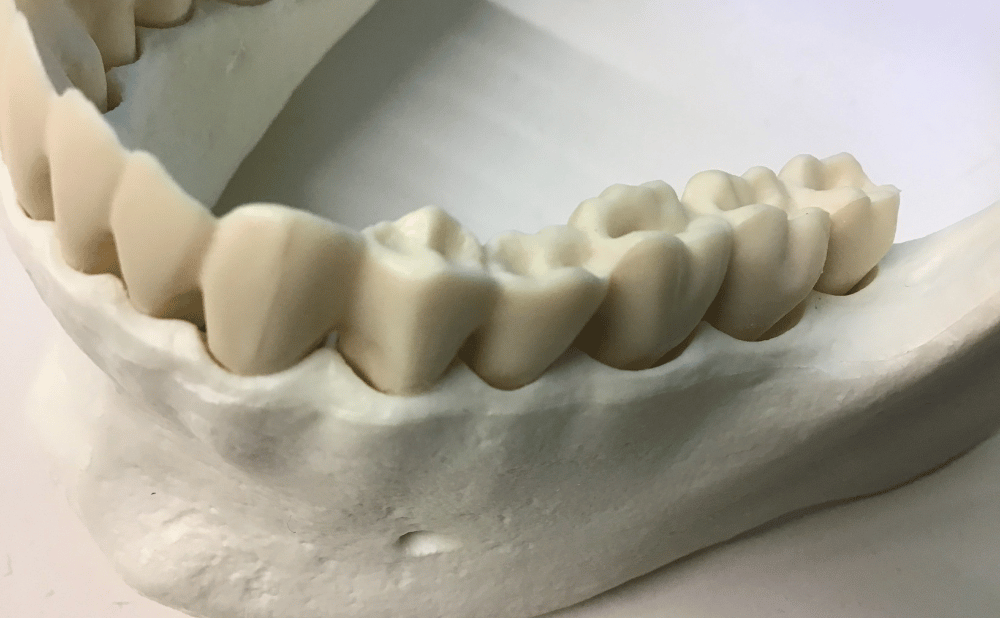 インプラントの根元が臭う原因