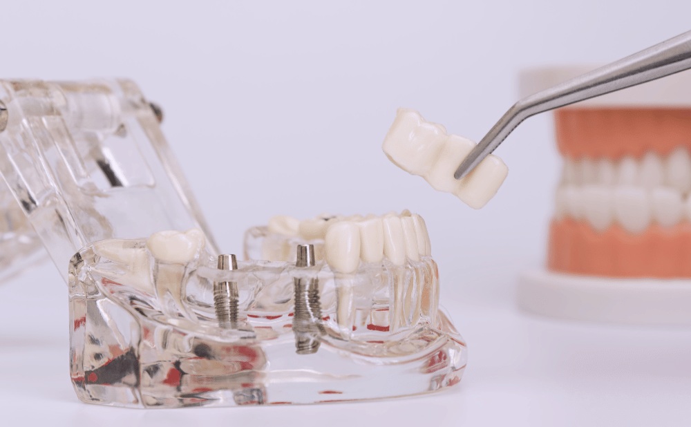 インプラント治療をすると口臭が発生するのか？