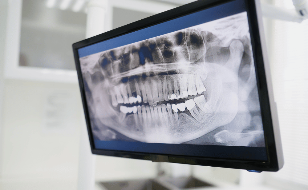 インビザラインをつけたまま食べ歩きするとどうなる？