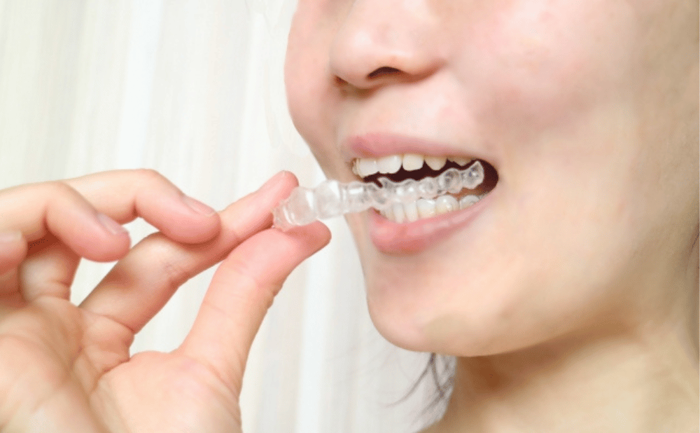 インビザラインの正しい外し方のコツ